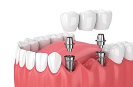 Illustration of implant bridge